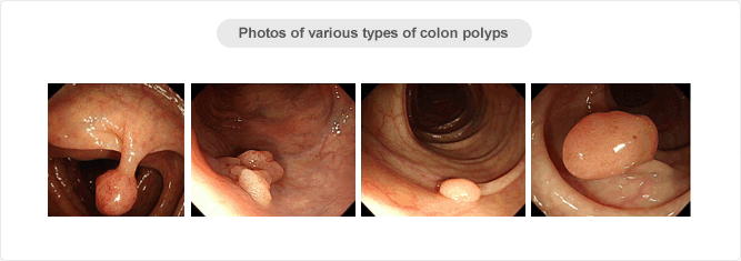 Photos of various types of colon polyps