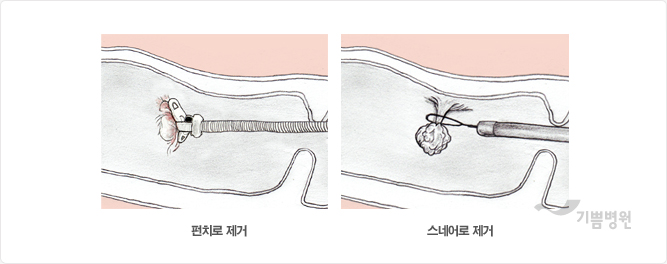 Small polyps are cut off with using a tool with forceps shaped like nipper. Big polyps are removed by passing looping and tightening a wire snare around the stalk of the polyp.