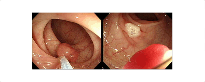 Photos of removes polyps