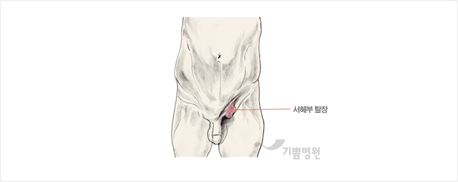 inguinal hernia